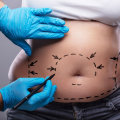 What is the life expectancy of a tummy tuck?