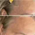 How long does it take to fully heal from top surgery?