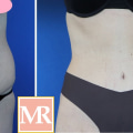 Can you tone your stomach after a tummy tuck?
