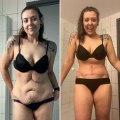 When will i feel like myself again after tummy tuck?
