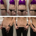What day do you start feeling better after tummy tuck?