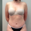 What is the satisfaction rate for a tummy tuck?