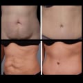 How long until tummy is flat after tummy tuck?