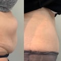 Do you ever get feeling back after a tummy tuck?