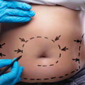 Does a tummy tuck permanently remove fat?