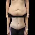 What percentage of tummy tucks are successful?