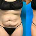 Why i chose not to get a tummy tuck?