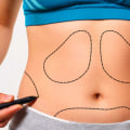 Do nerves grow back after tummy tuck?