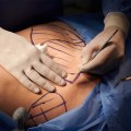 What is the survival rate of plastic surgery?