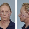 Are most people happy after a facelift?