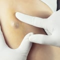 Should a plastic surgeon or dermatologist remove a cyst?