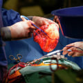 What percentage of heart transplant surgeries are successful?