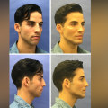 What is the most difficult facial plastic surgery?