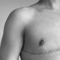 How long do you have to sleep propped up after top surgery?