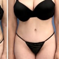 What hurts more bbl or tummy tuck?