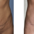 Can you tear your tummy tuck?