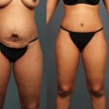 Is tummy tuck worth the risk?