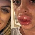 What percent of plastic surgeries go wrong?
