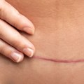 What is the failure rate of tummy tuck?