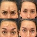 What category does botox fall under?