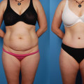 What happens to a tummy tuck as you age?