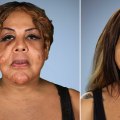 What plastic surgery has the lowest satisfaction rate?