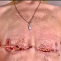 Is top surgery hard to recover from?