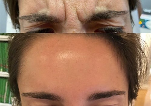 What toxin is used in plastic surgery?