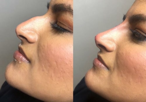 What is the least painful cosmetic surgery?