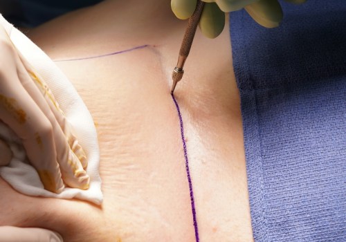 What chemicals are used in plastic surgery?