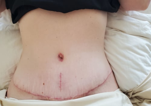 Are tummy tuck complications common?