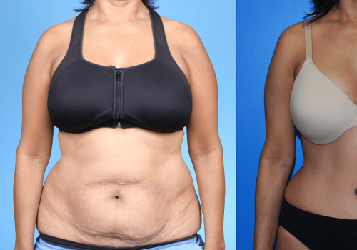 How can i slim down after a tummy tuck?