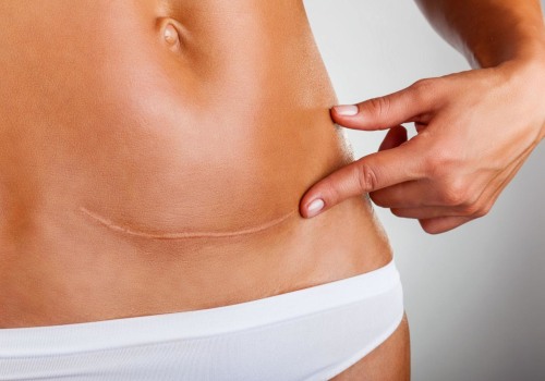 What are red flags after a tummy tuck?