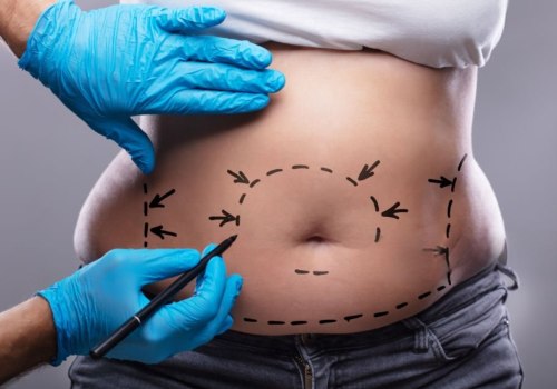 What is the life expectancy of a tummy tuck?