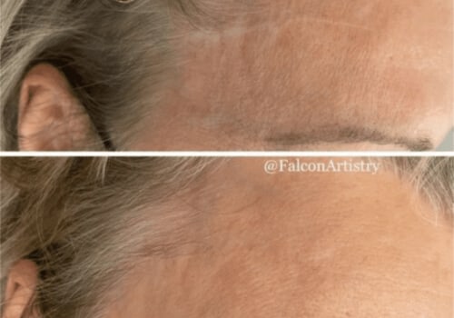 How long does it take to fully heal from top surgery?