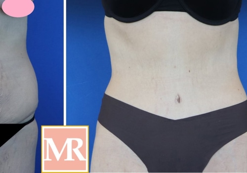 Can you tone your stomach after a tummy tuck?
