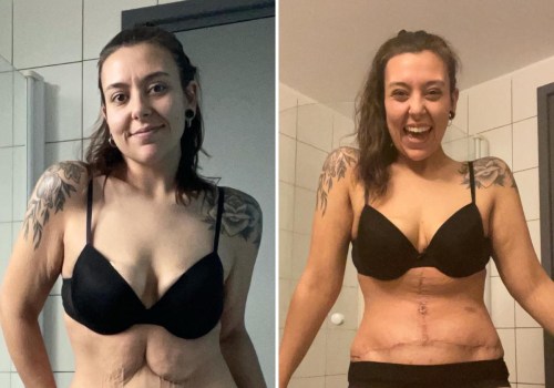 When will i feel like myself again after tummy tuck?