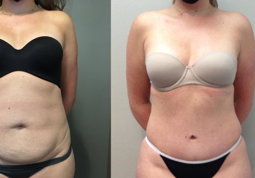 What is the satisfaction rate for a tummy tuck?