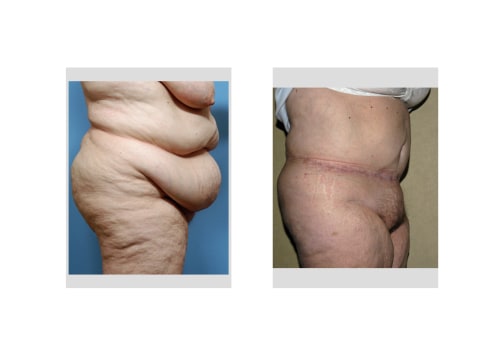 How do you get rid of upper belly bulge after tummy tuck?