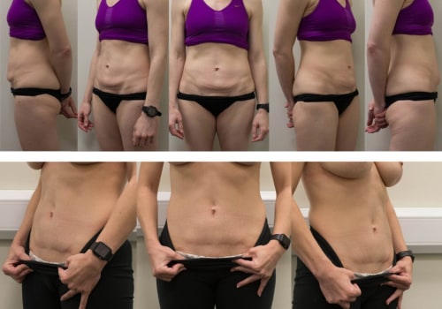 When do you start feeling better after a tummy tuck?