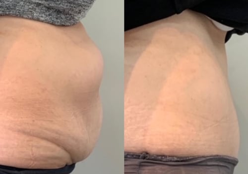 Do you ever get feeling back after a tummy tuck?