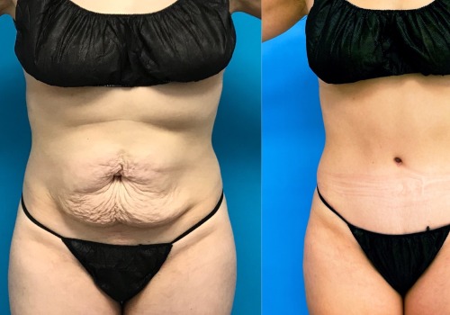 Why i chose not to get a tummy tuck?