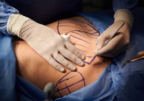 What is the survival rate of plastic surgery?