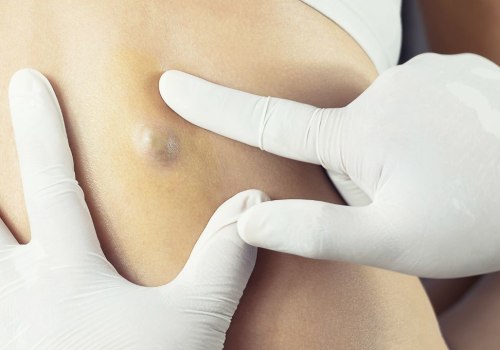 Should a plastic surgeon or dermatologist remove a cyst?