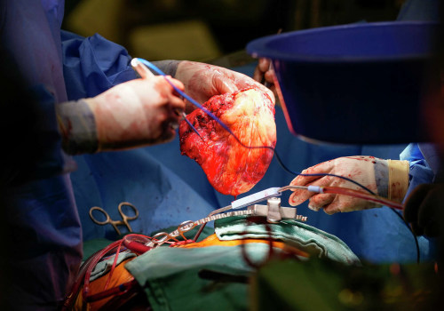 What percentage of heart transplant surgeries are successful?