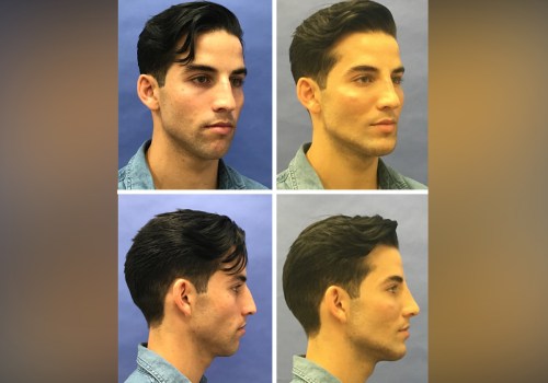 What is the most difficult facial plastic surgery?