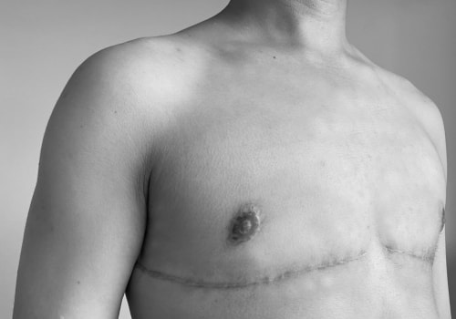 How long do you have to sleep propped up after top surgery?