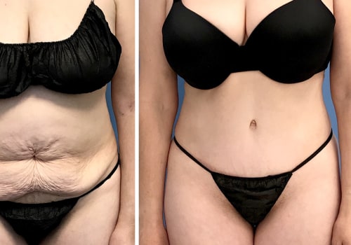 What hurts more bbl or tummy tuck?