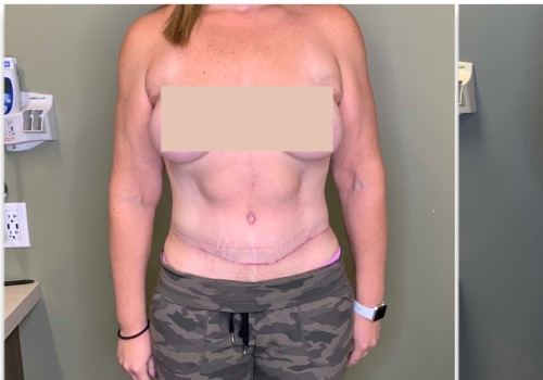What does no one tell you about a tummy tuck?