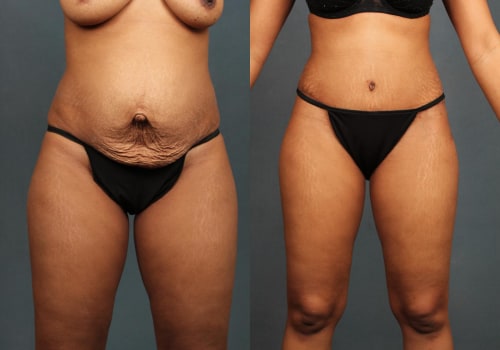 Is tummy tuck worth the risk?
